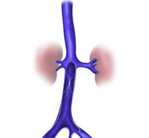 Gore completes first-in-human implants of Viafort vascular stent