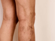 Meta-analysis of PTS finds one in five at risk of long-term symptoms following isolated distal DVT DVT