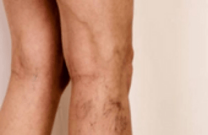 Meta-analysis of PTS finds one in five at risk of long-term symptoms following isolated distal DVT DVT