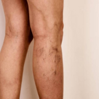 Meta-analysis of PTS finds one in five at risk of long-term symptoms following isolated distal DVT DVT