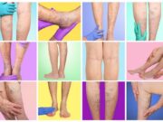 Varicose vein registry analysis finds women benefit from endovenous ablation with fewer complications