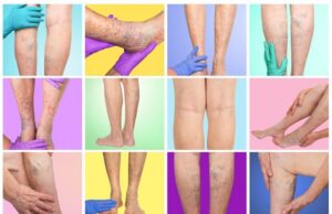 Varicose vein registry analysis finds women benefit from endovenous ablation with fewer complications