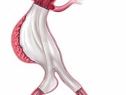 ESVS AAA guidelines alert recommends ‘enhanced surveillance’ in patients treated with Nellix device nellix