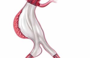 ESVS AAA guidelines alert recommends ‘enhanced surveillance’ in patients treated with Nellix device nellix