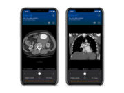 New clinical data support AI solution for improved PE detection and care coordination