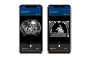 New clinical data support AI solution for improved PE detection and care coordination