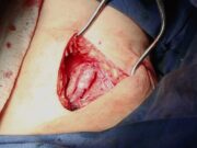 Bioprosthetic venous valve: ‘We want to know that this is really working’