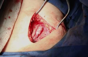 Bioprosthetic venous valve: ‘We want to know that this is really working’