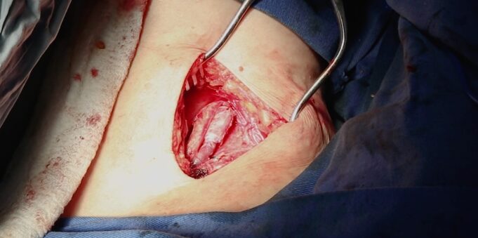 Bioprosthetic venous valve: ‘We want to know that this is really working’