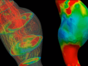 Computational model found to predict early aortic abdominal aneurysm rupture abdominal aortic aneurysm