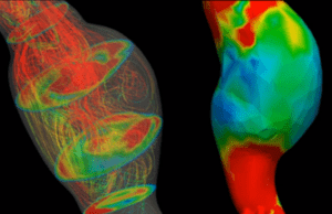 Computational model found to predict early aortic abdominal aneurysm rupture abdominal aortic aneurysm