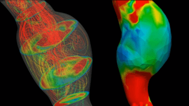 Computational model found to predict early aortic abdominal aneurysm rupture abdominal aortic aneurysm