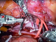 Robotic surgery: ‘We’ve missed the boat on this,’ says Houston vascular chief