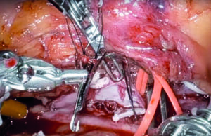 Robotic surgery: ‘We’ve missed the boat on this,’ says Houston vascular chief