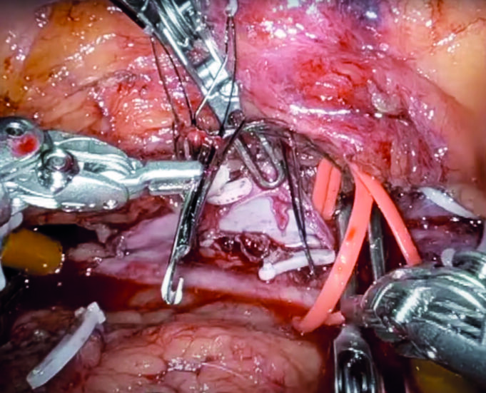 Robotic surgery: ‘We’ve missed the boat on this,’ says Houston vascular chief