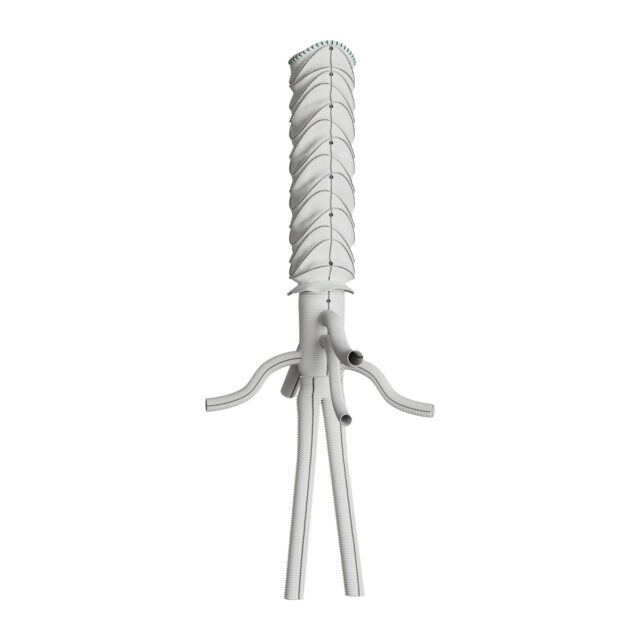 First implant of custom-made thoracoabdominal hybrid device in North America announced