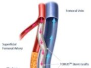Endologix announces first patients treated with the Detour system