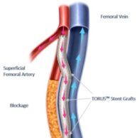 Endologix announces first patients treated with the Detour system