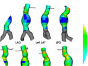 New study reports positive performance of AI-powered assessment of biomarkers for growth prediction of AAAs