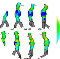 New study reports positive performance of AI-powered assessment of biomarkers for growth prediction of AAAs