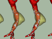 Endovascular stablization system for infrarenal AAAs gains FDA Fast Track designation