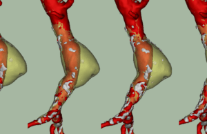 Endovascular stablization system for infrarenal AAAs gains FDA Fast Track designation