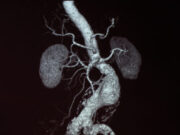 First US patient enrolled in SOCRATES short neck AAA trial