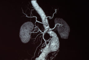 First US patient enrolled in SOCRATES short neck AAA trial