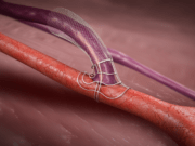 VasQ AVF creation device receives FDA clearance