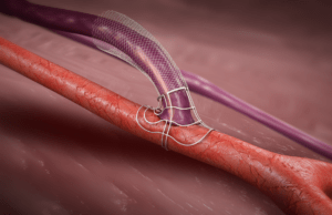 VasQ AVF creation device receives FDA clearance