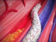 FDA approves LimFlow system for ‘no-option’ CLTI patients