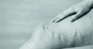 SVS varicose vein guideline webinar set for Oct. 10