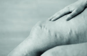 SVS varicose vein guideline webinar set for Oct. 10