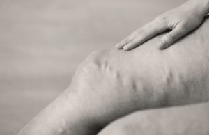 New varicose vein management guidelines released