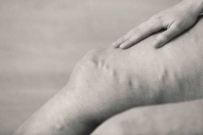 New varicose vein management guidelines released