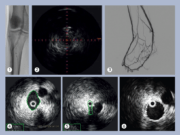 Use of IVUS reduces patient risk of MALE or death by up to 28%: Data support consensus views on importance of advanced visualization for peripheral vascular disease interventions