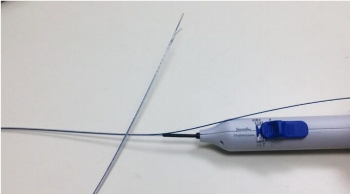 Intravenous anesthesia delivery during varicose vein treatment proves safe and reduces pain scores, researcher reports