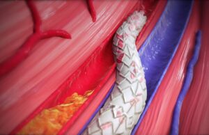 LimFlow announces agreement to be acquired by Inari Medical agreement