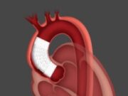 First patient treated in ARISE II study of ascending stent graft