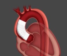 First patient treated in ARISE II study of ascending stent graft