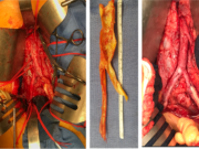 Re-evaluating aortoiliac endarterectomy: Case series shows ‘acceptable durability’