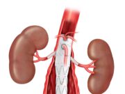 First patient treated in ZFEN+ fenestrated endovascular graft study