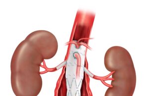 First patient treated in ZFEN+ fenestrated endovascular graft study