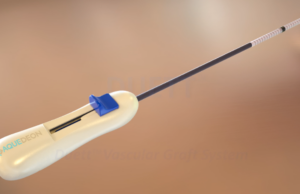 First patient enrolled in IDE study of Aquedeon Medical’s Duett vascular graft system