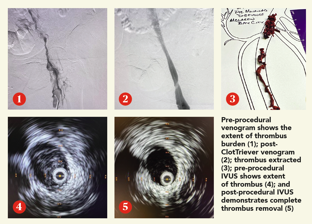 Single-session thrombus removal with the ClotTriever BOLD