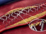 FDA Breakthrough Device designation granted for DynamX BTK for use in CLTI treatment below the knee