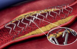 FDA Breakthrough Device designation granted for DynamX BTK for use in CLTI treatment below the knee