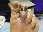 Incorporation of Shockwave E8 Peripheral IVL into the treatment of patients with chronic limb-threatening ischemia