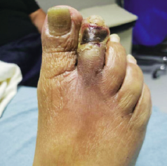 Incorporation of Shockwave E8 Peripheral IVL into the treatment of patients with chronic limb-threatening ischemia