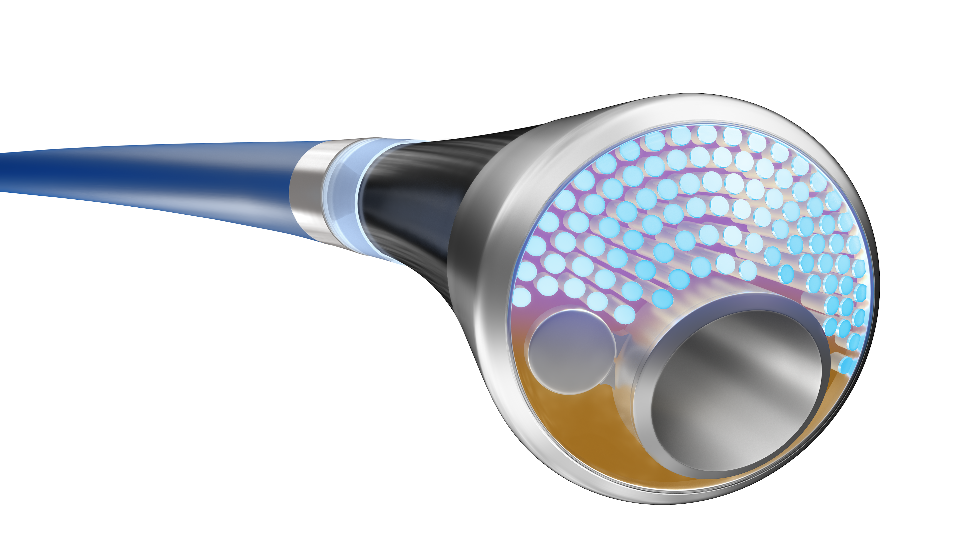 First patient enrolled in study of integrated laser atherectomy and IVL catheter